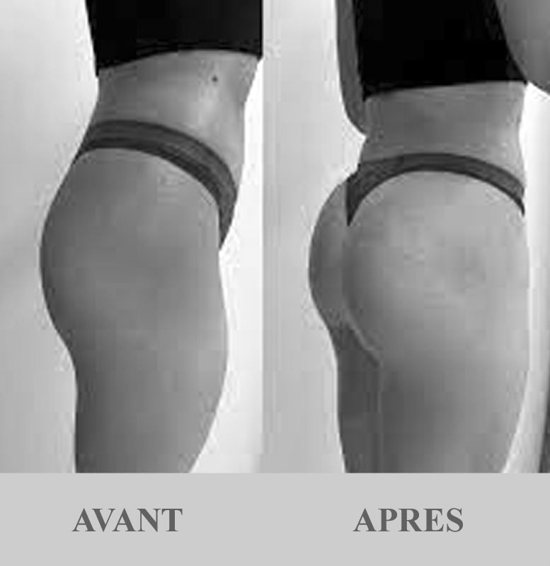 fenugrec fessiers avant-après